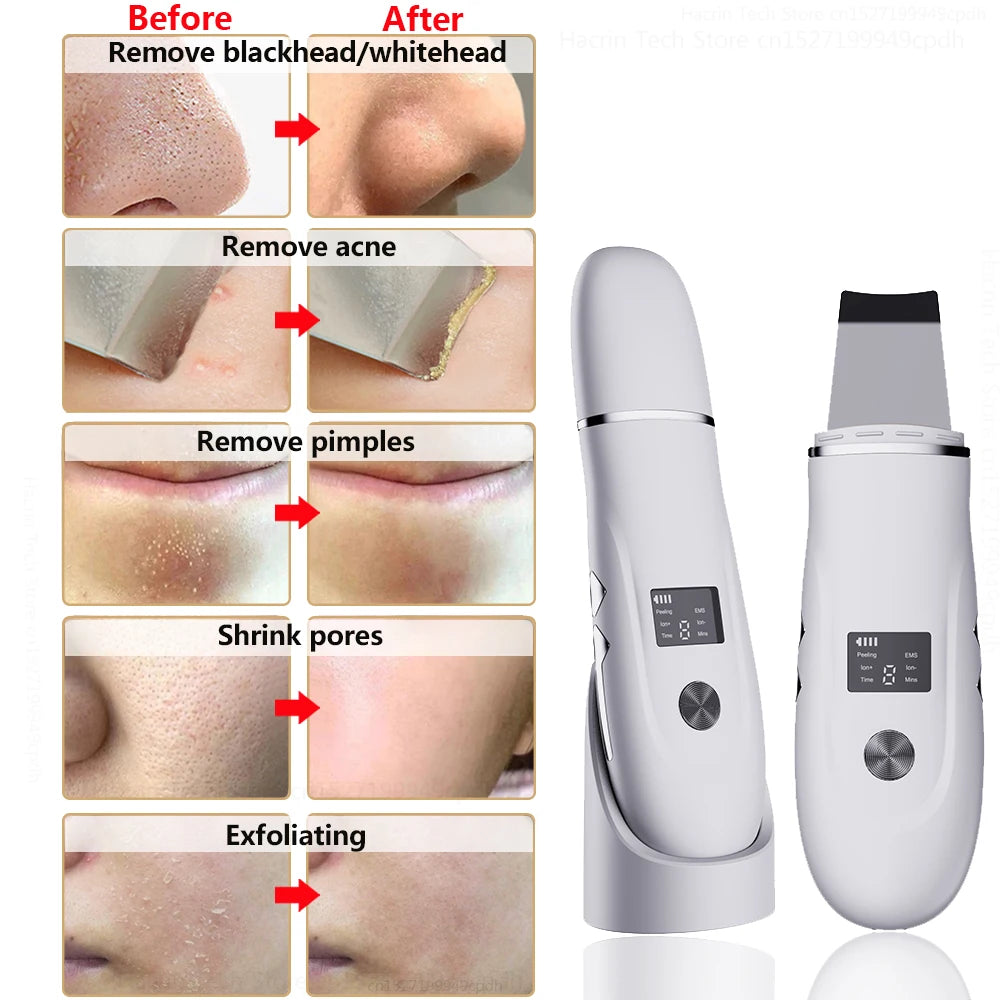 Ultrasonic Face Scrubber Facial Peeling Skin Scrubber Deep Facial Cleaning Spatula Acne Pore Ultrasonic Scrubber Facial Cleanser