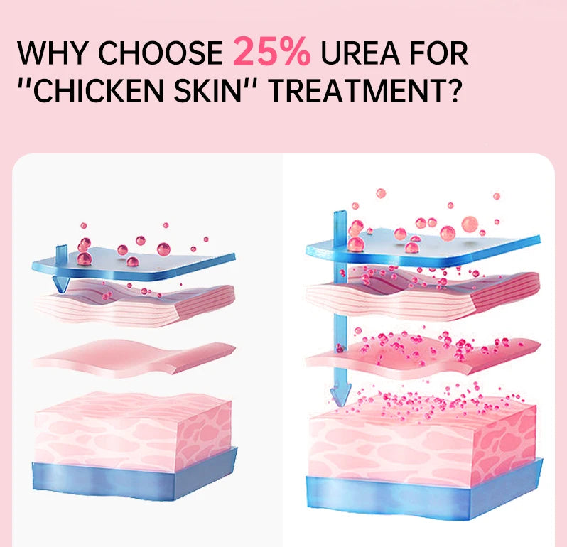 Chicken Skin Cream Keratosis Pilaris Treatment Chicken Remover